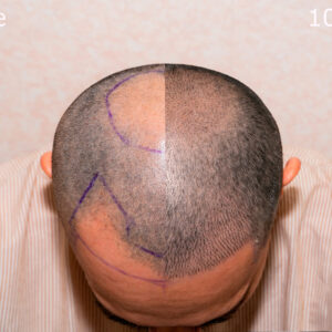 IMPLANTES CAPILARES HANDS ON