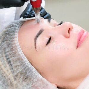 MICRONEEDLING HANDS ON